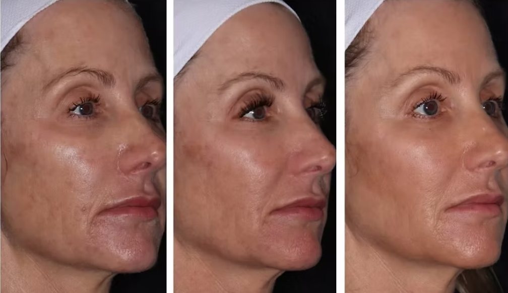 Before, during and after microneedling, profile view