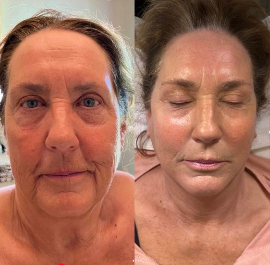 Before and after photos of a client's face