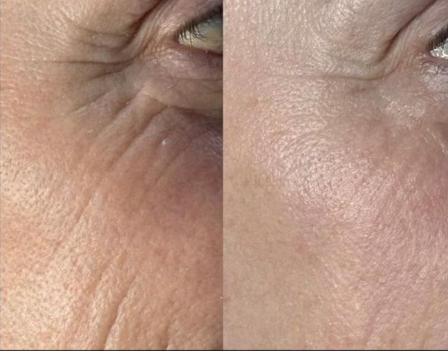 Before and after close-up of the eye area