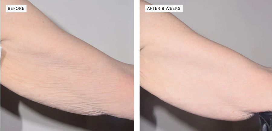 Alastin before and after photos of an arm, after 8 weeks