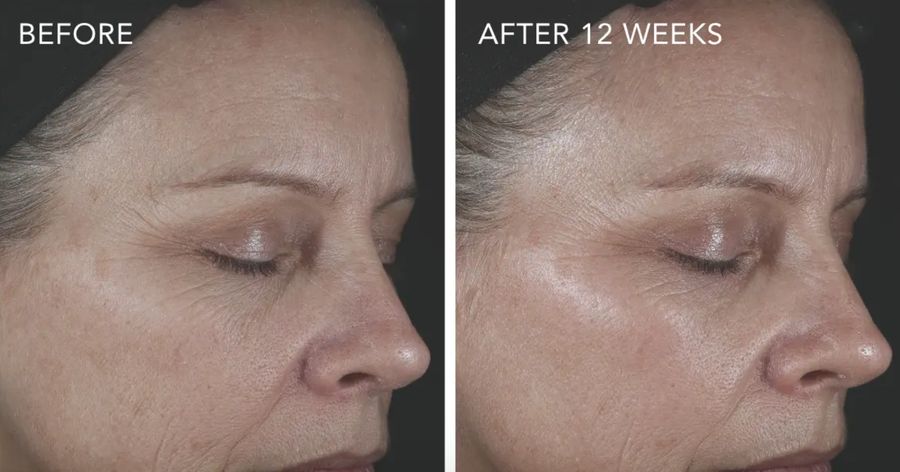 Alastin before and after photos of the face in profile, after 12 weeks