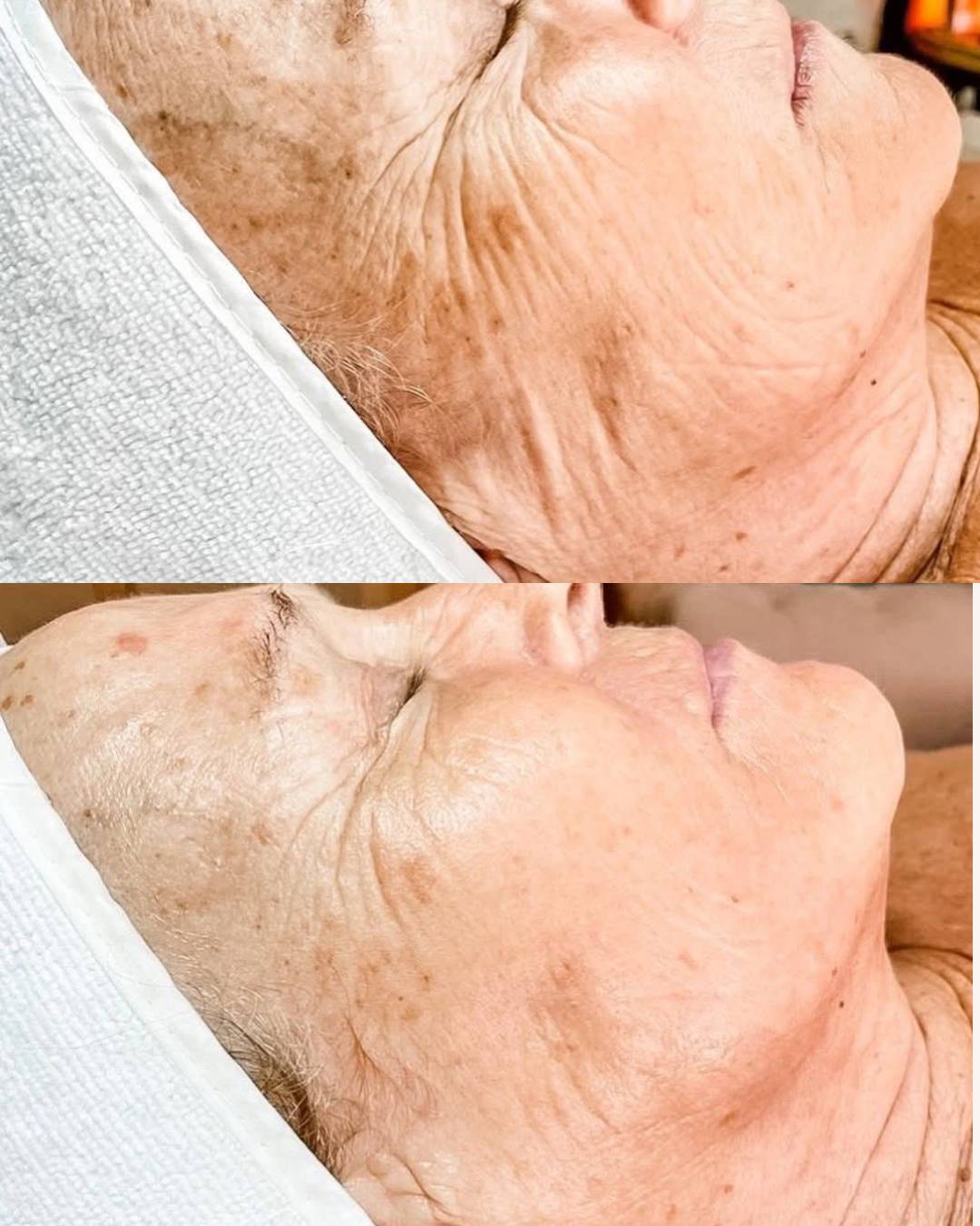 NeurotriS microcurrent treatment