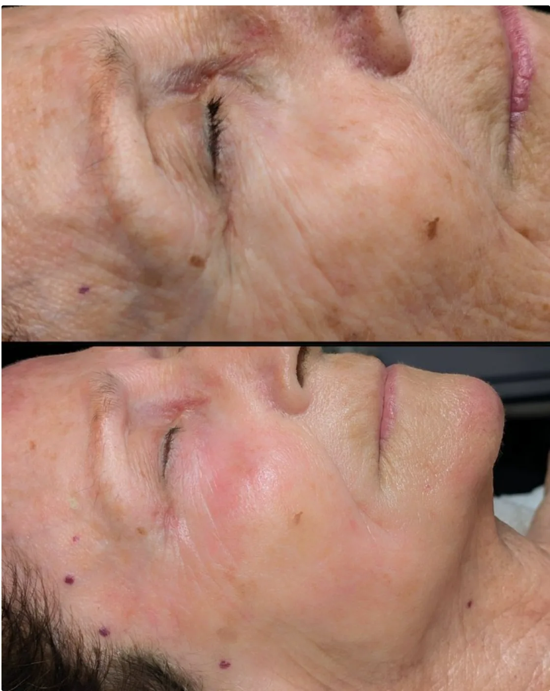 Client result after one Detox & Rebuild treatment, age 77